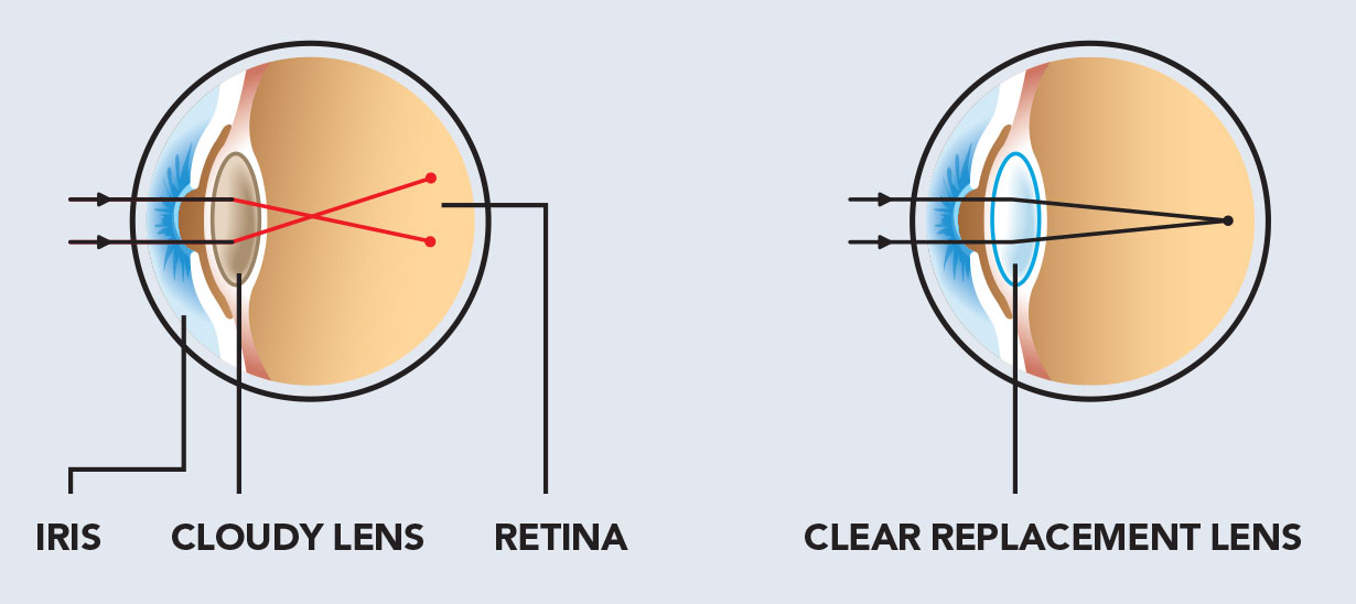 A diagram of the treatment for cataracts