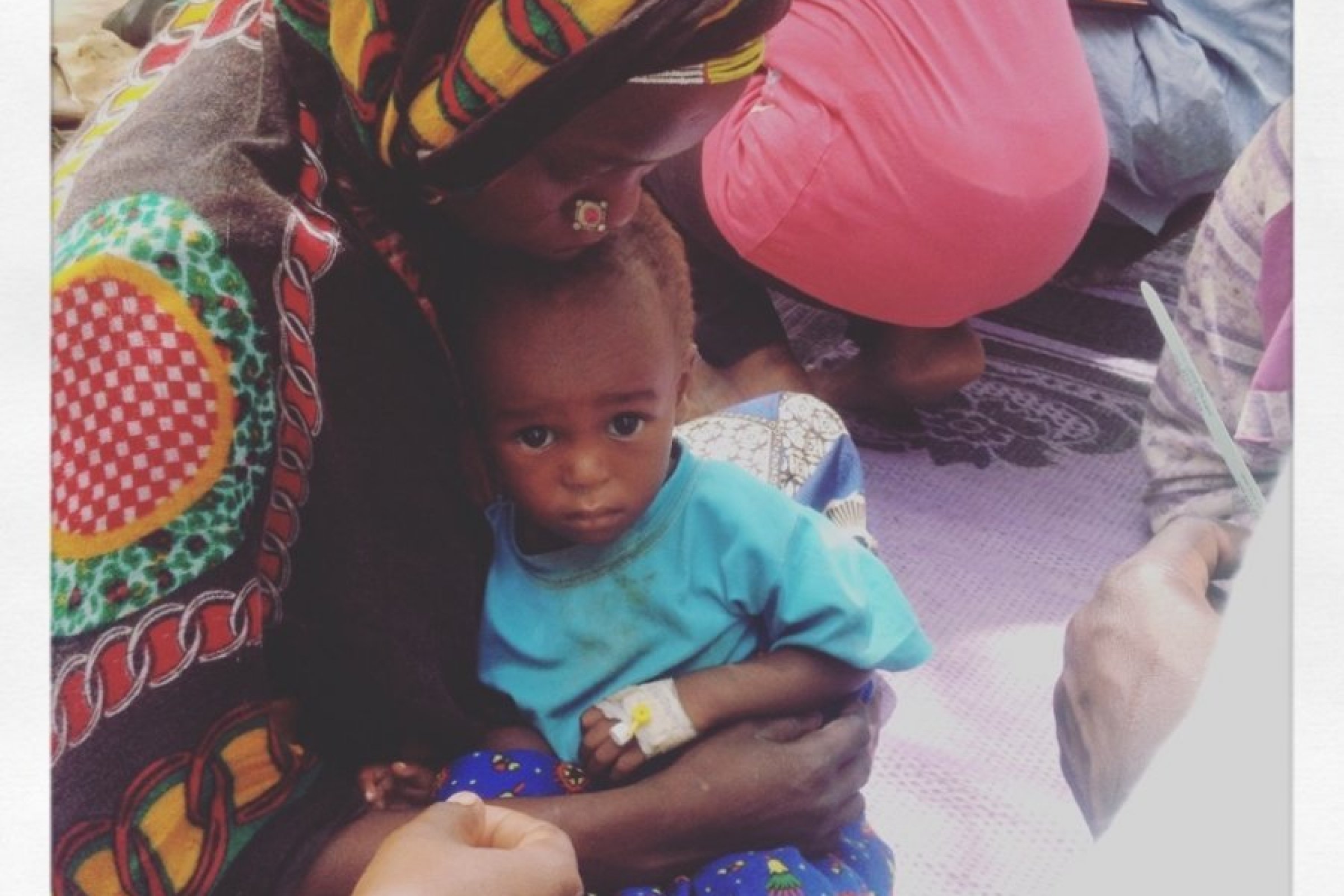 A child at an MSF therapeutic feeding centre in Chad